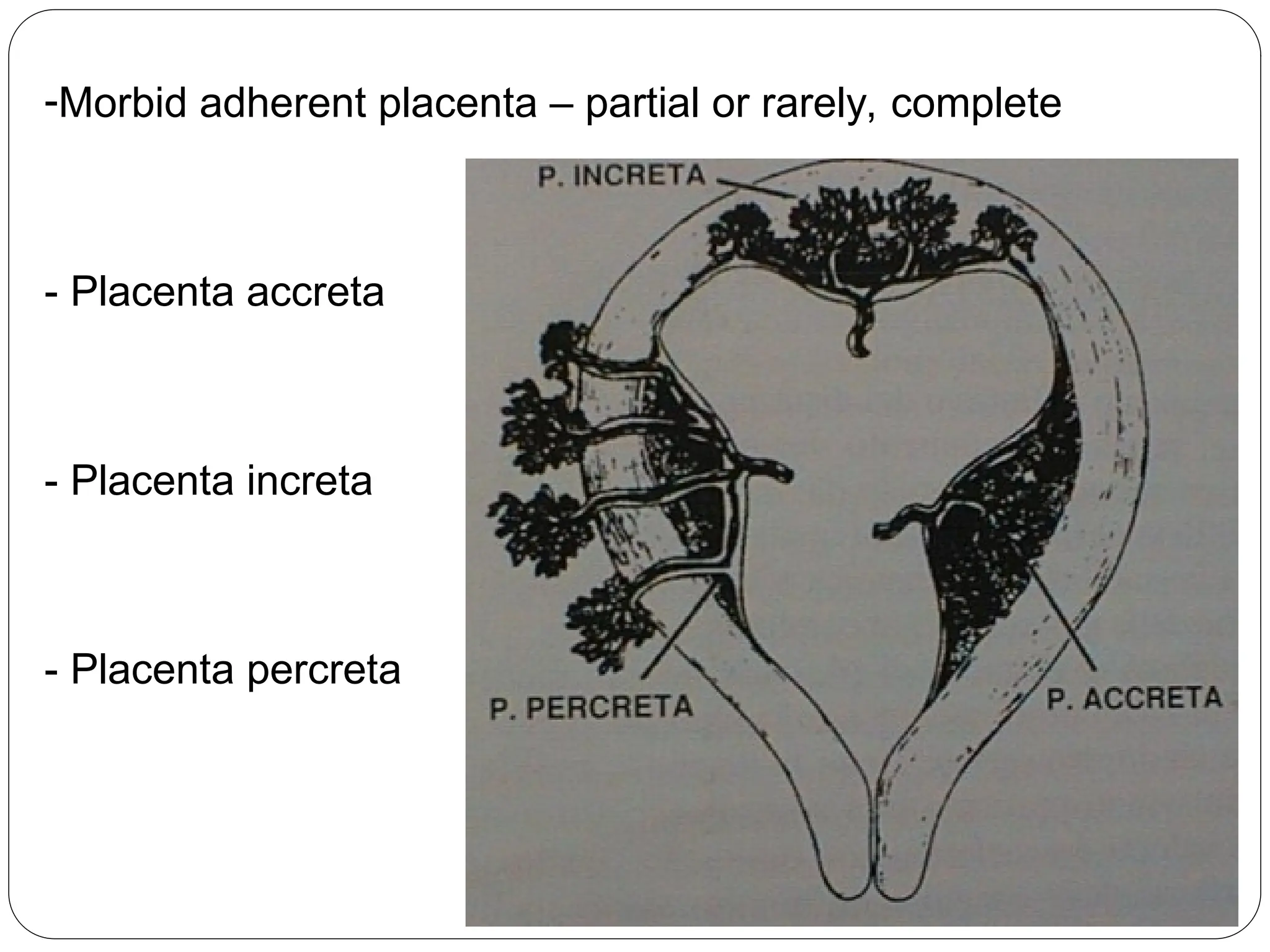 -Morbid adherent placenta – partial or rarely, complete
- Placenta accreta
- Placenta increta
- Placenta percreta
 