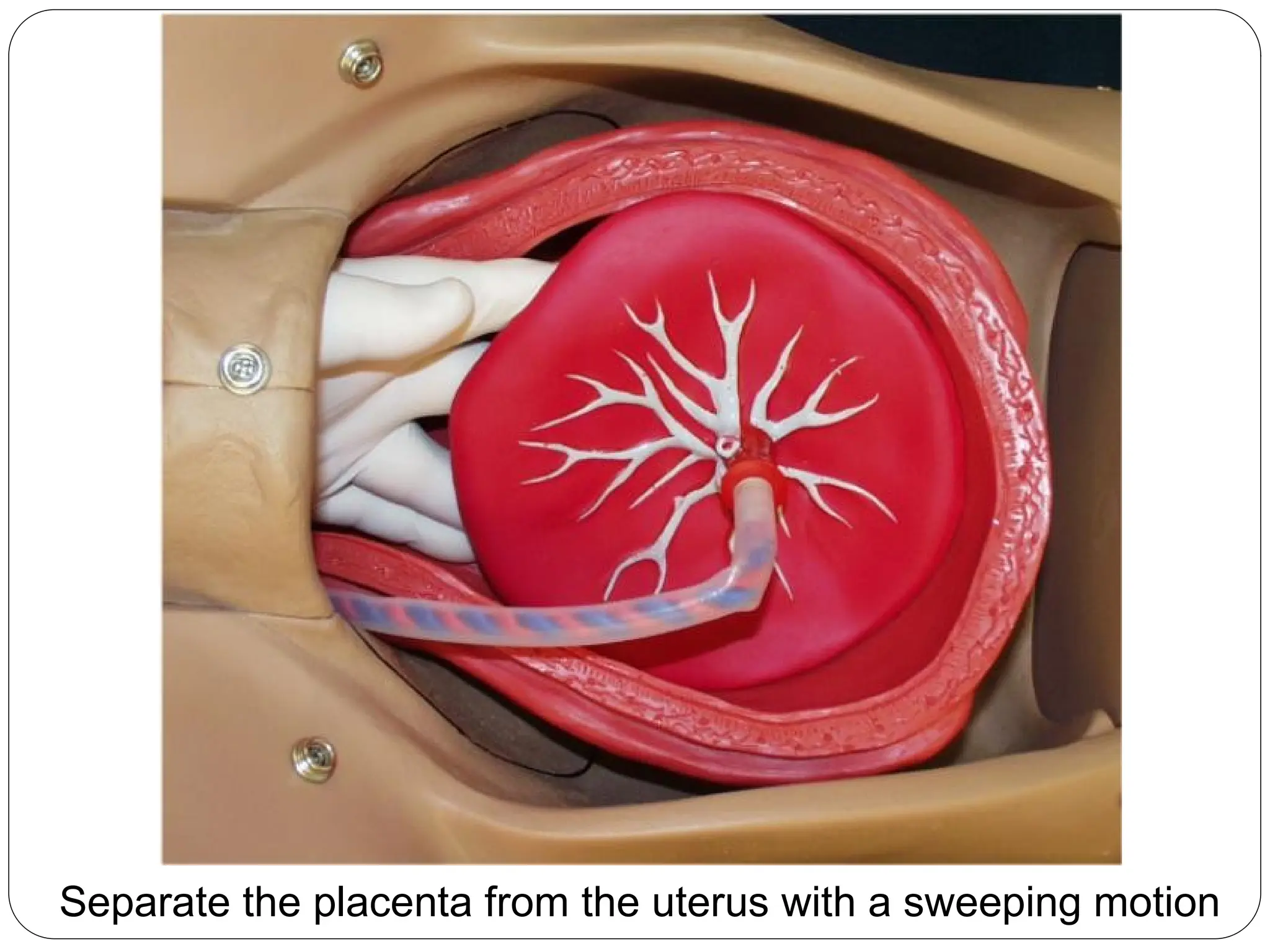 Separate the placenta from the uterus with a sweeping motion
 