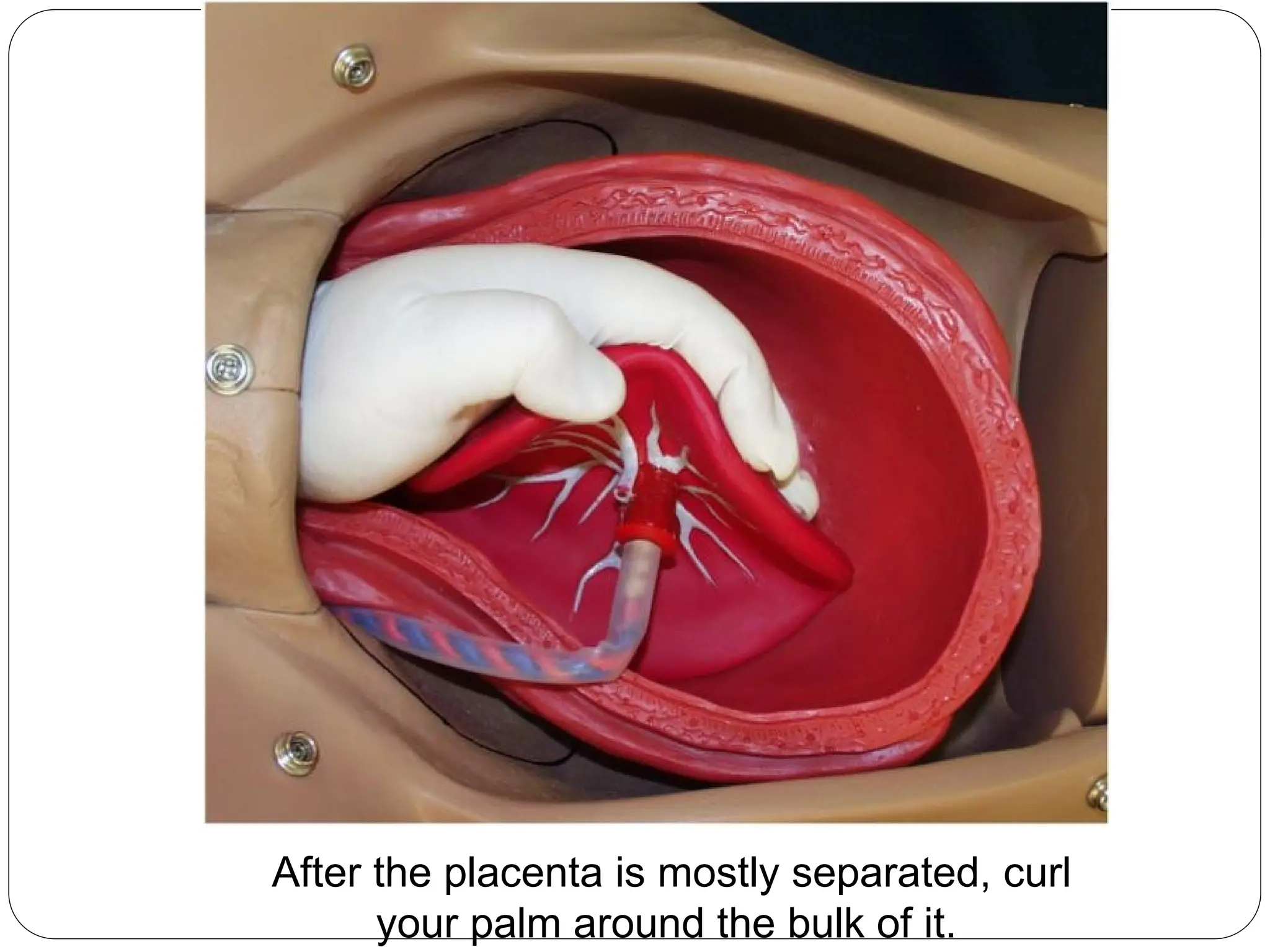 After the placenta is mostly separated, curl
your palm around the bulk of it.
 