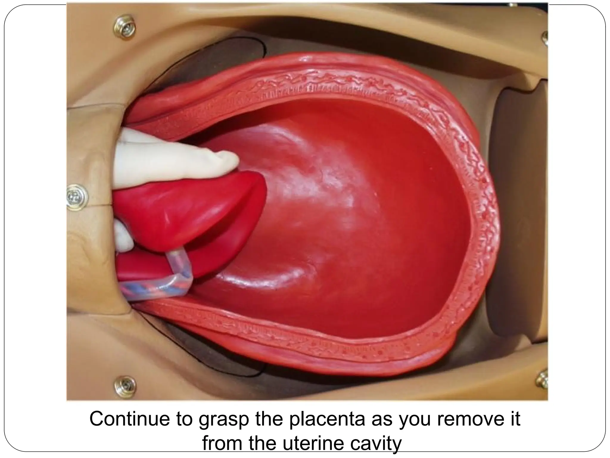 Continue to grasp the placenta as you remove it
from the uterine cavity
 