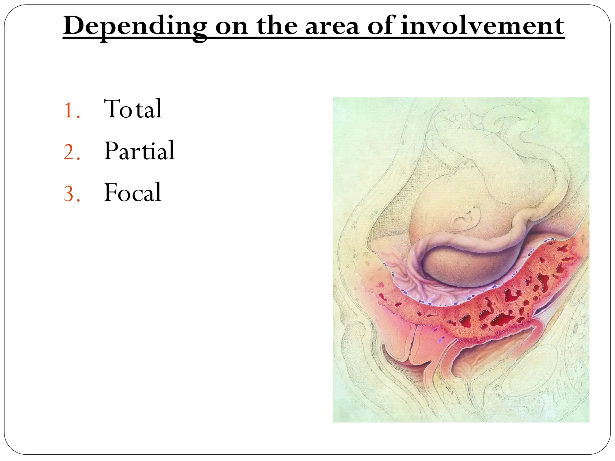 Depending on the area of involvement
1. Total
2. Partial
3. Focal
 