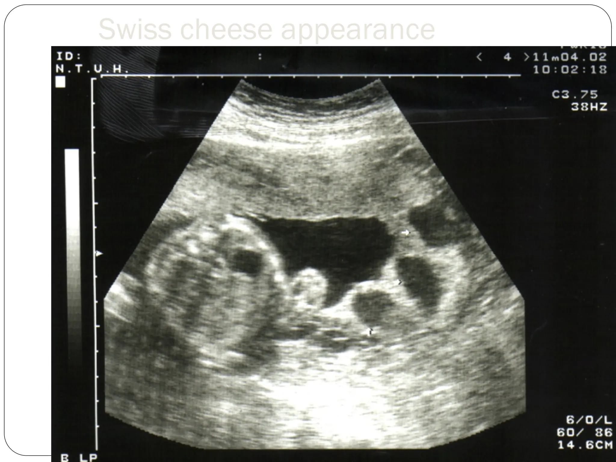 Swiss cheese appearance
 