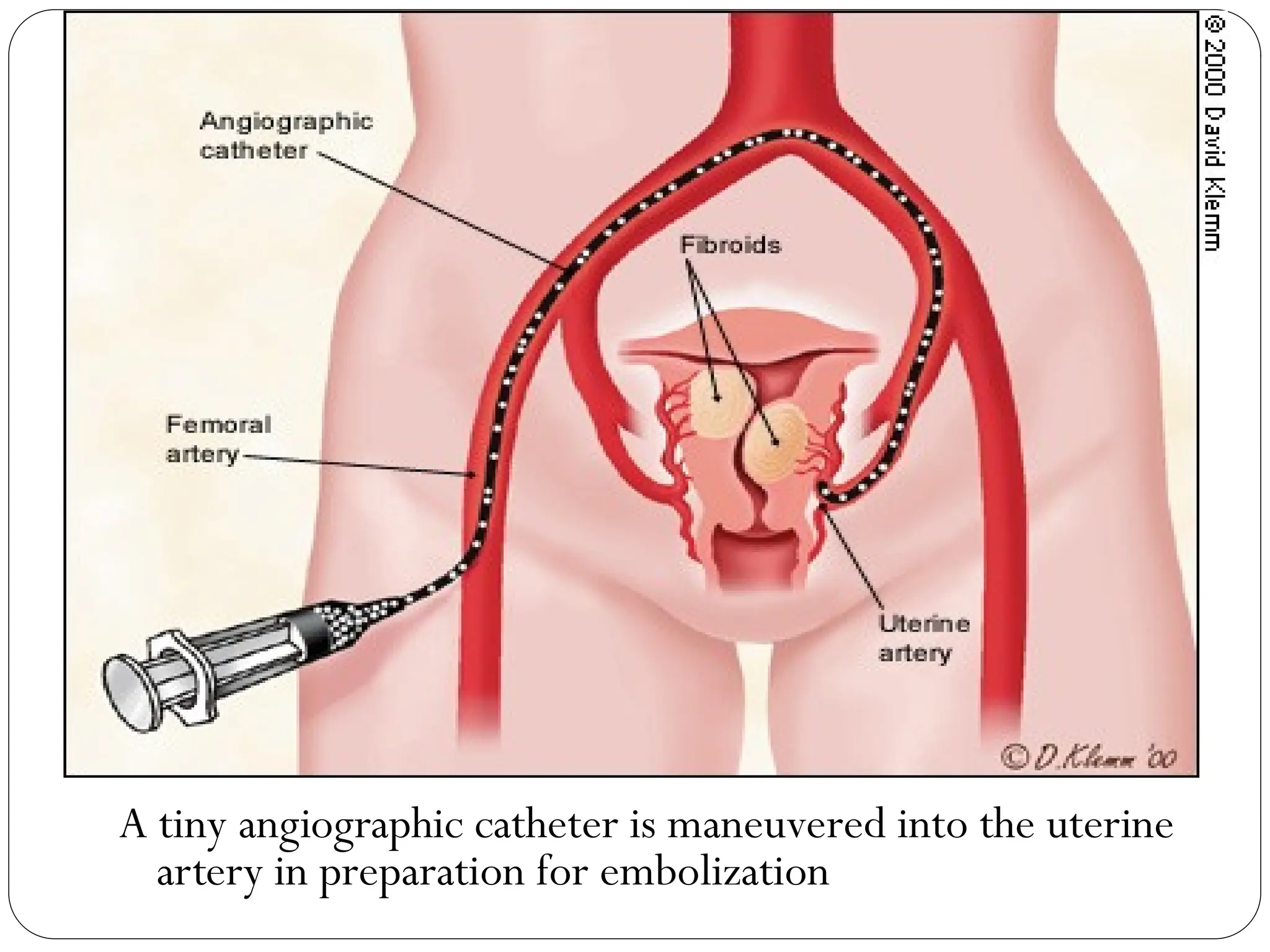 A tiny angiographic catheter is maneuvered into the uterine
artery in preparation for embolization
 