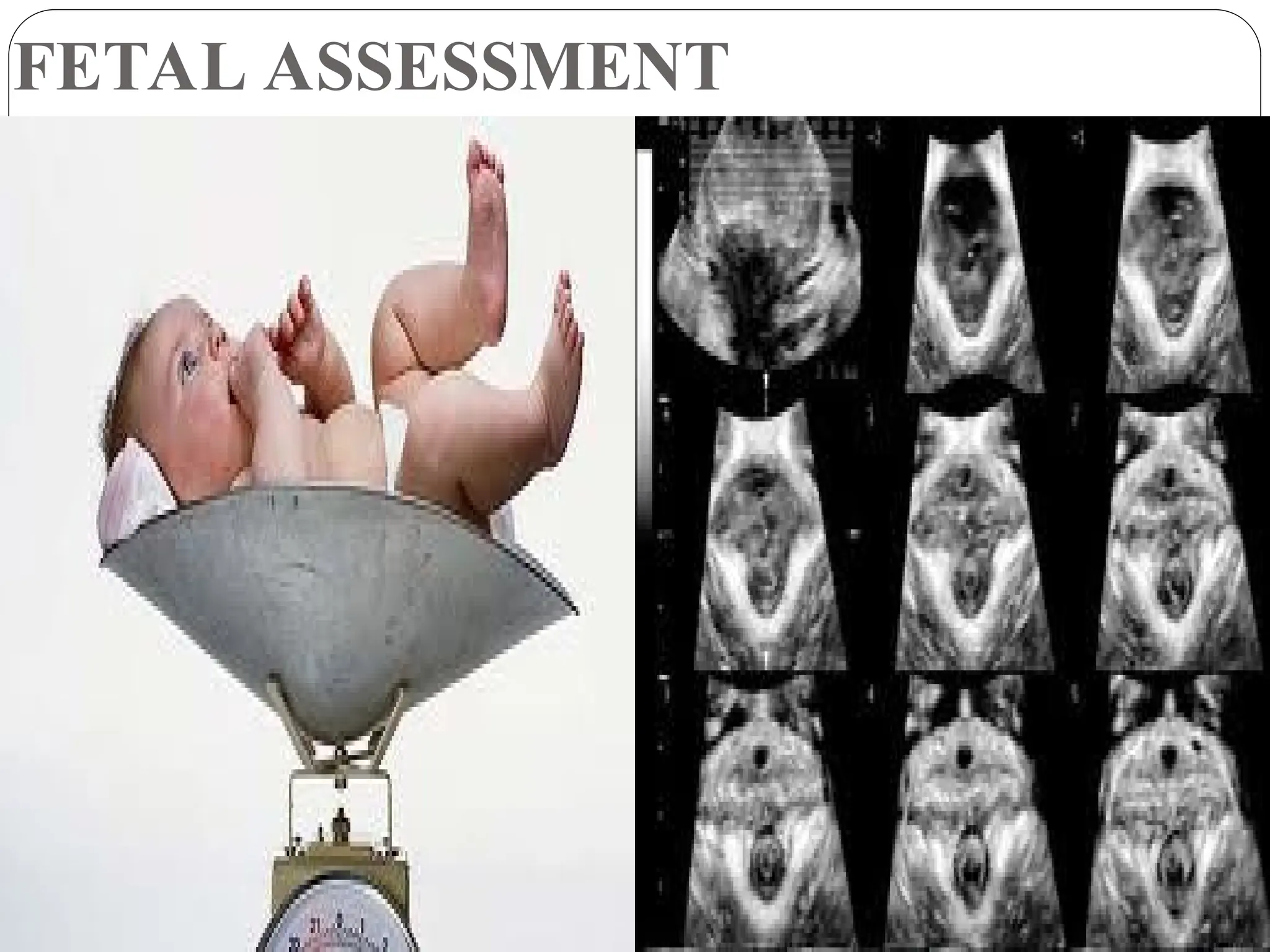 FETAL ASSESSMENT
 