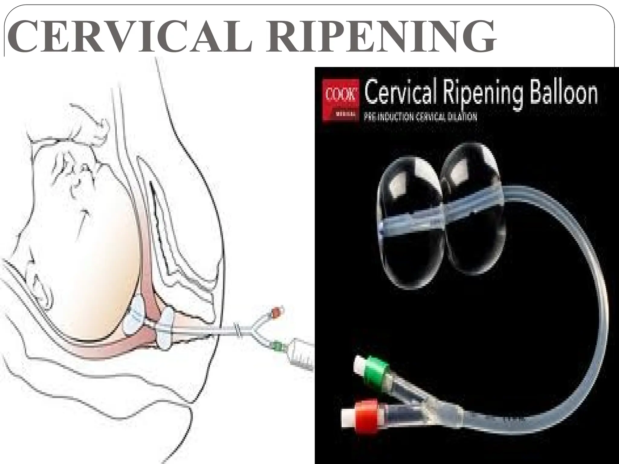 CERVICAL RIPENING
 