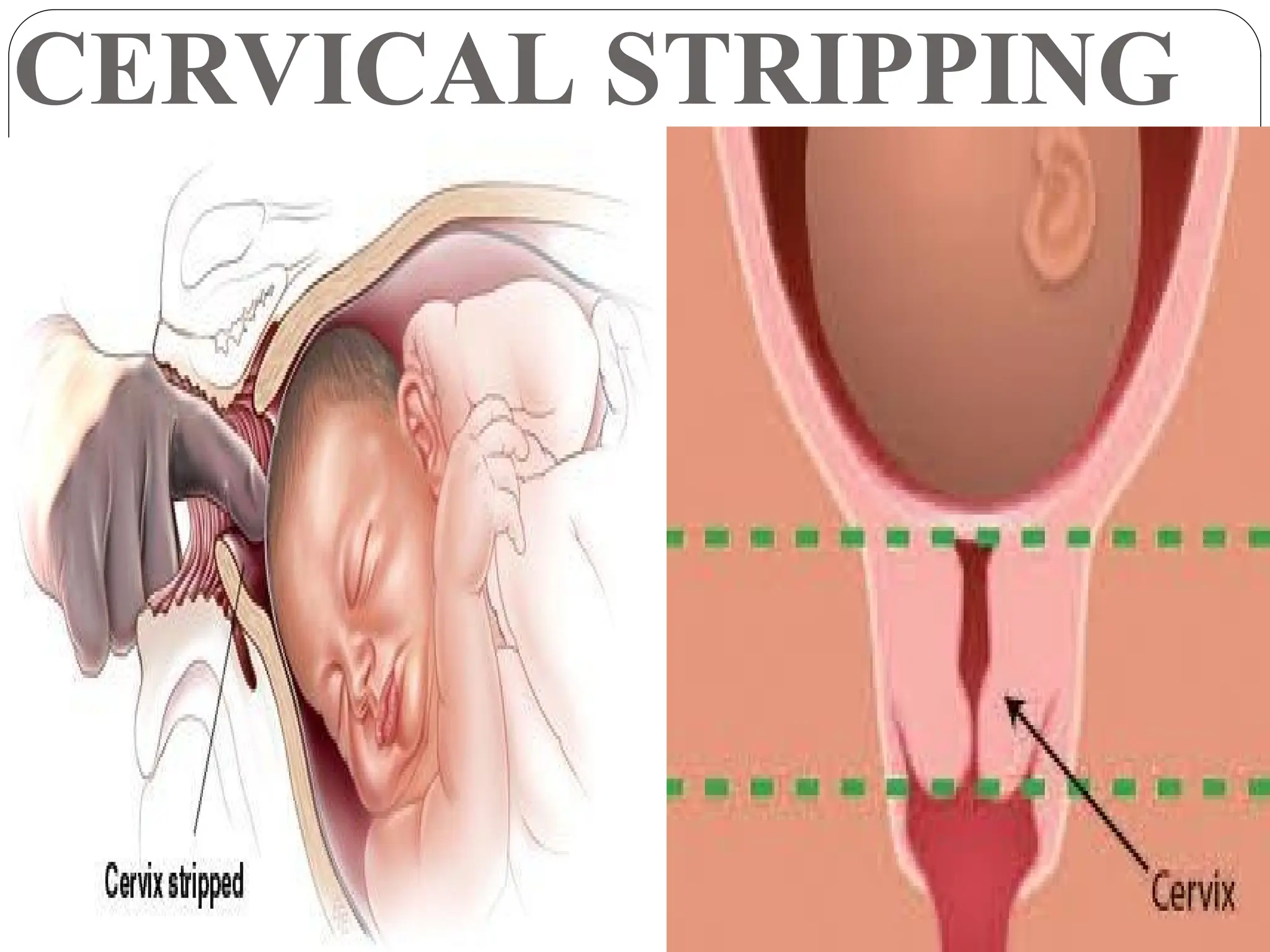 CERVICAL STRIPPING
 