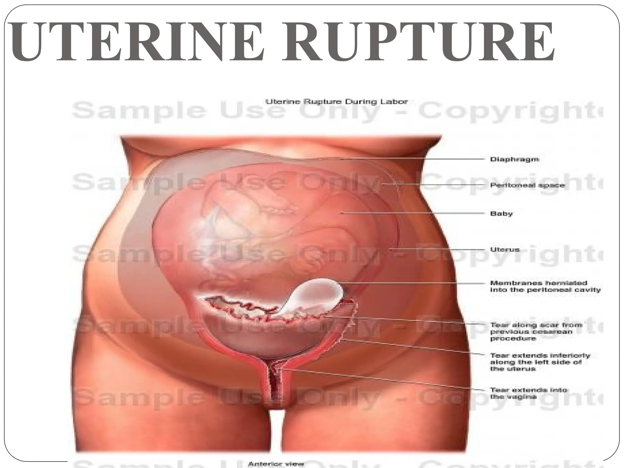 UTERINE RUPTURE
 