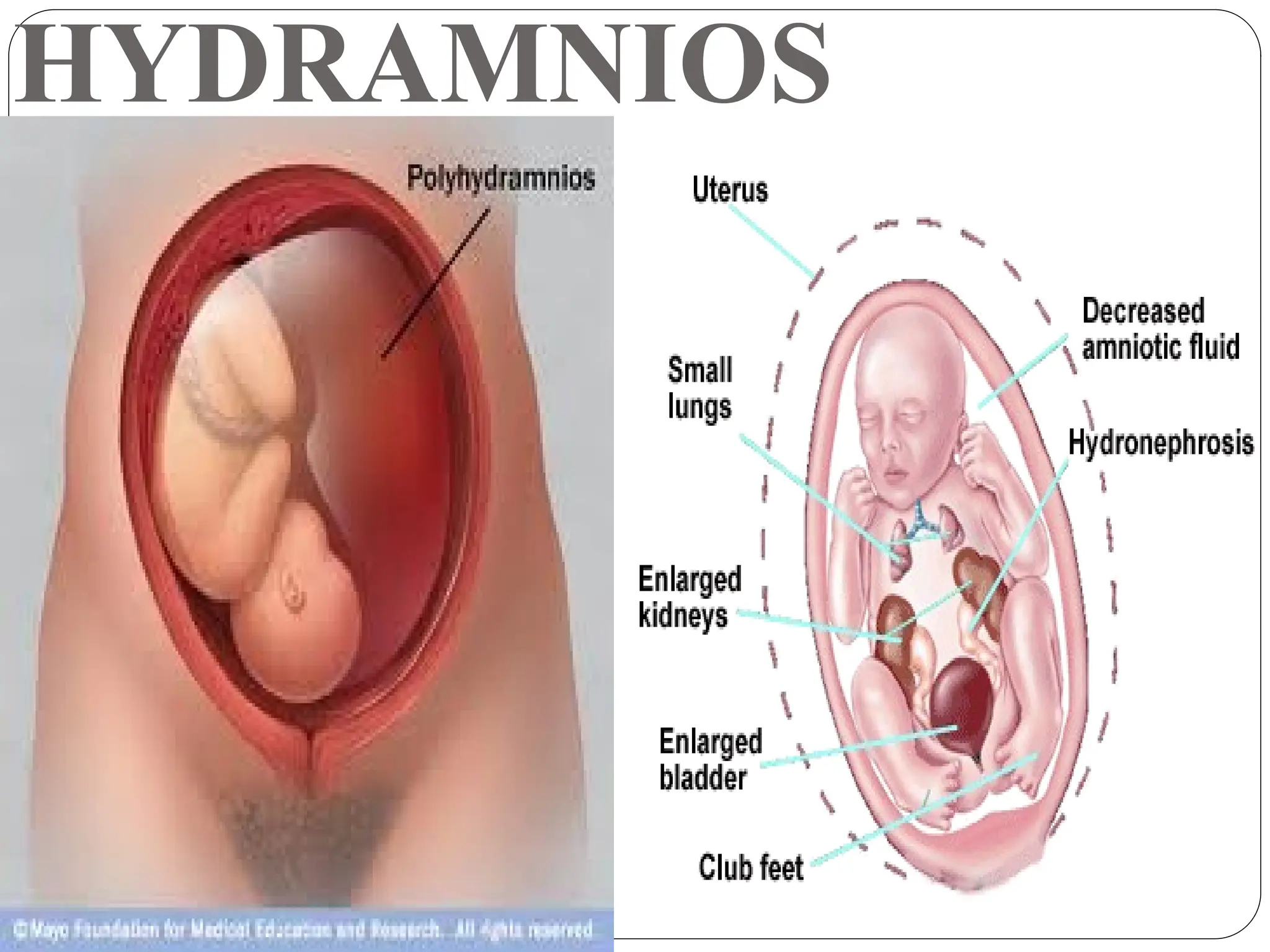 HYDRAMNIOS
 
