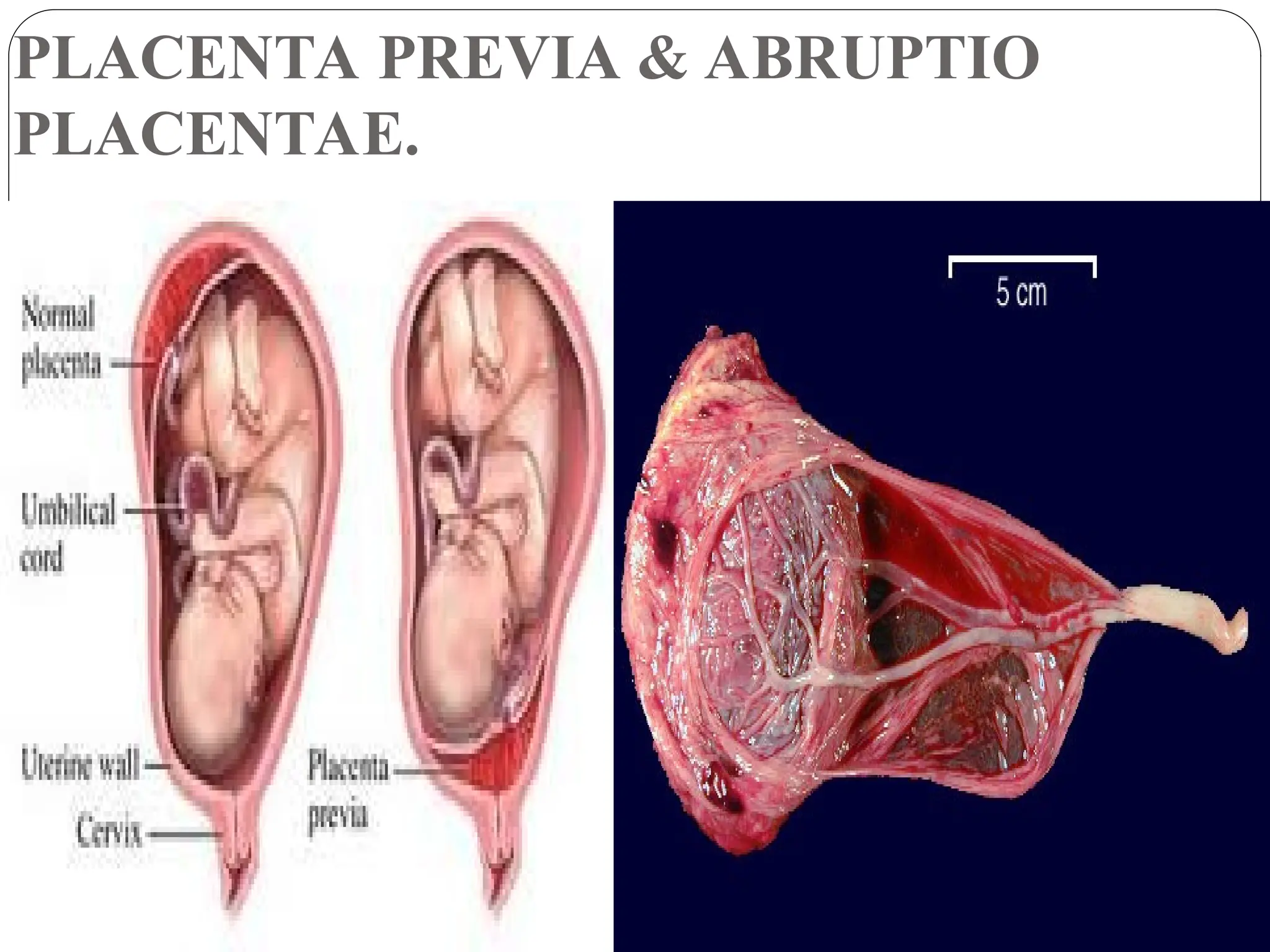 PLACENTA PREVIA & ABRUPTIO
PLACENTAE.
 