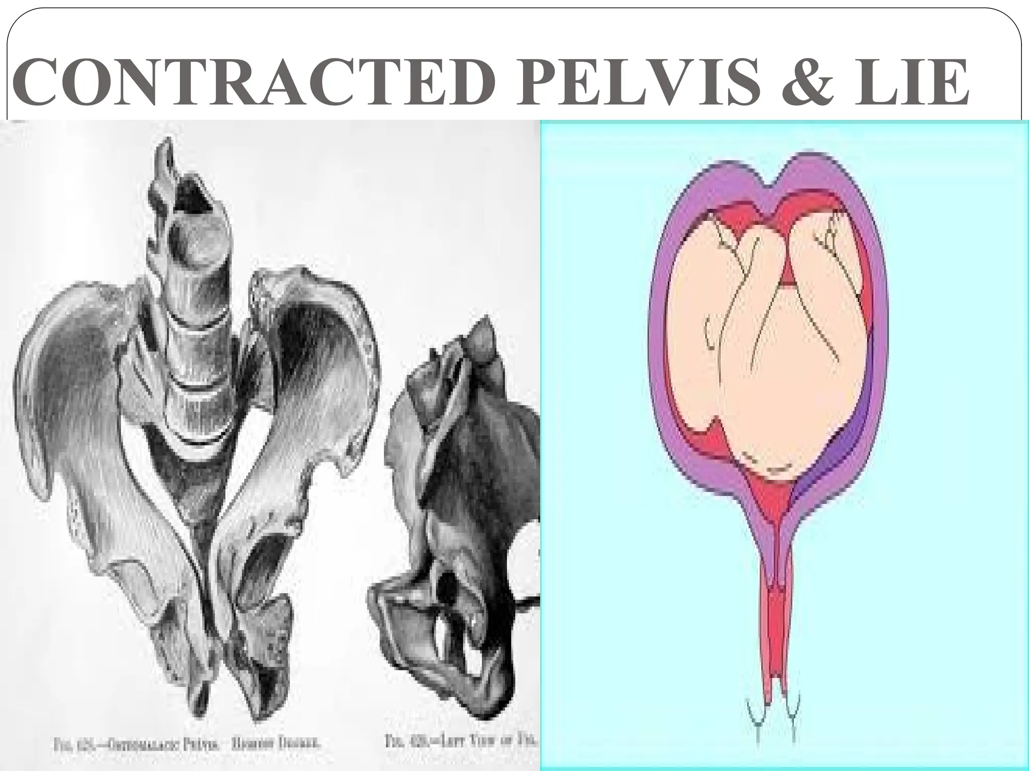 CONTRACTED PELVIS & LIE
 