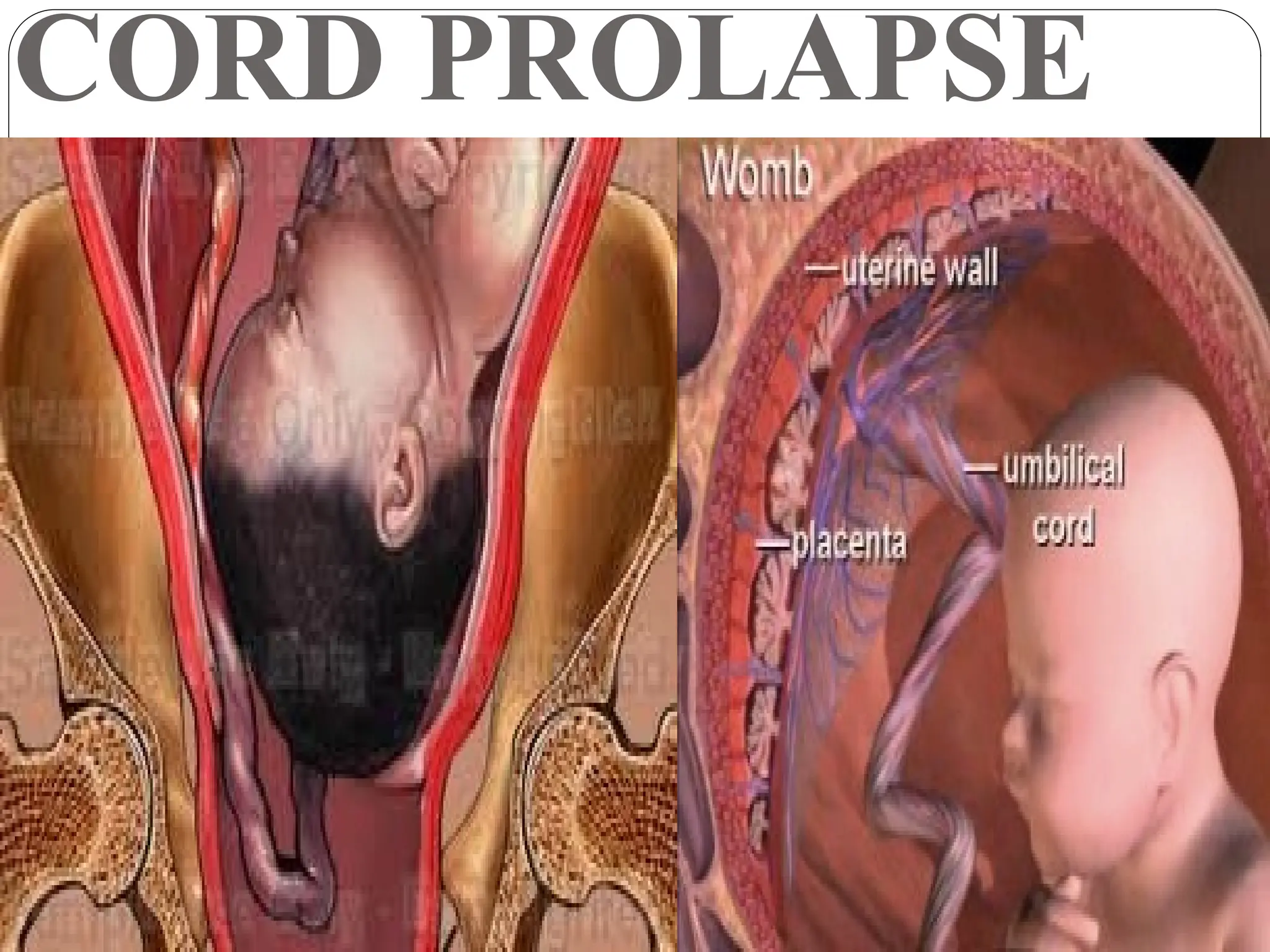 CORD PROLAPSE
 