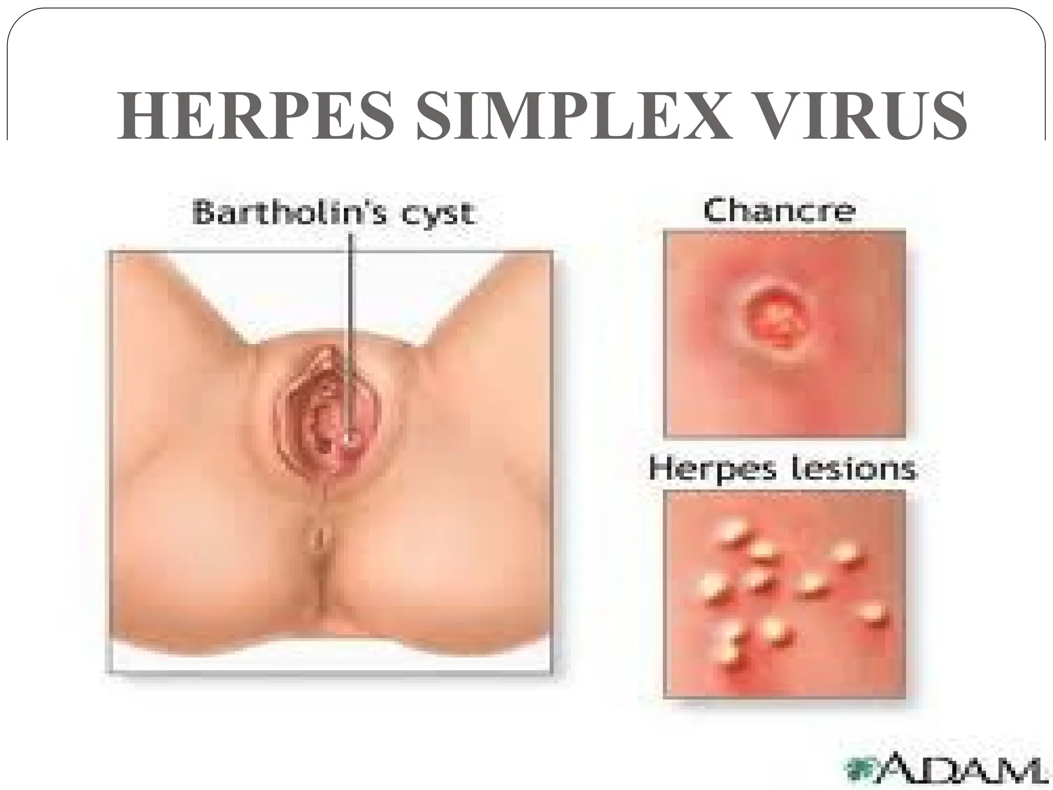 HERPES SIMPLEX VIRUS
 