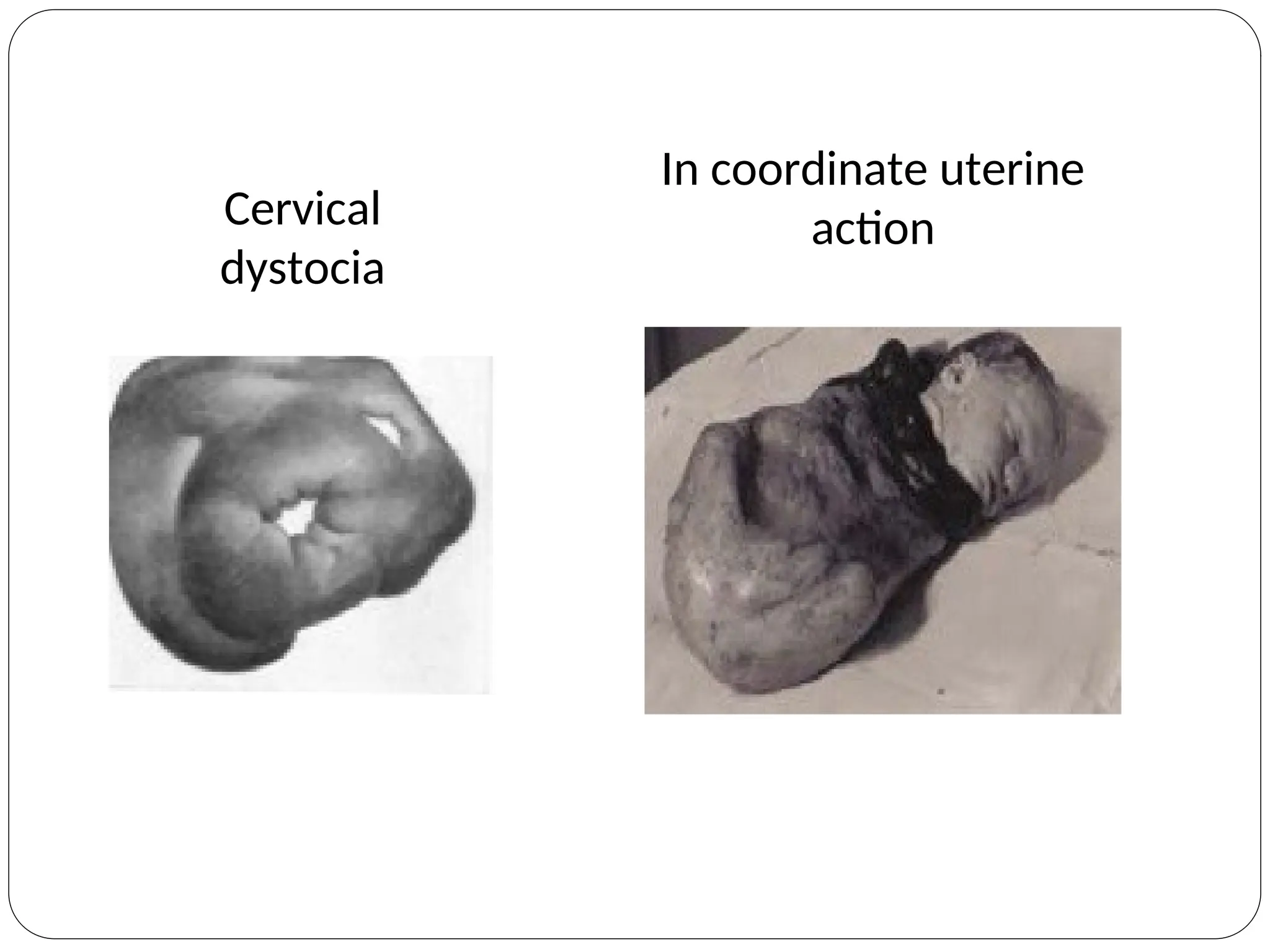 Cervical
dystocia
In coordinate uterine
action
 