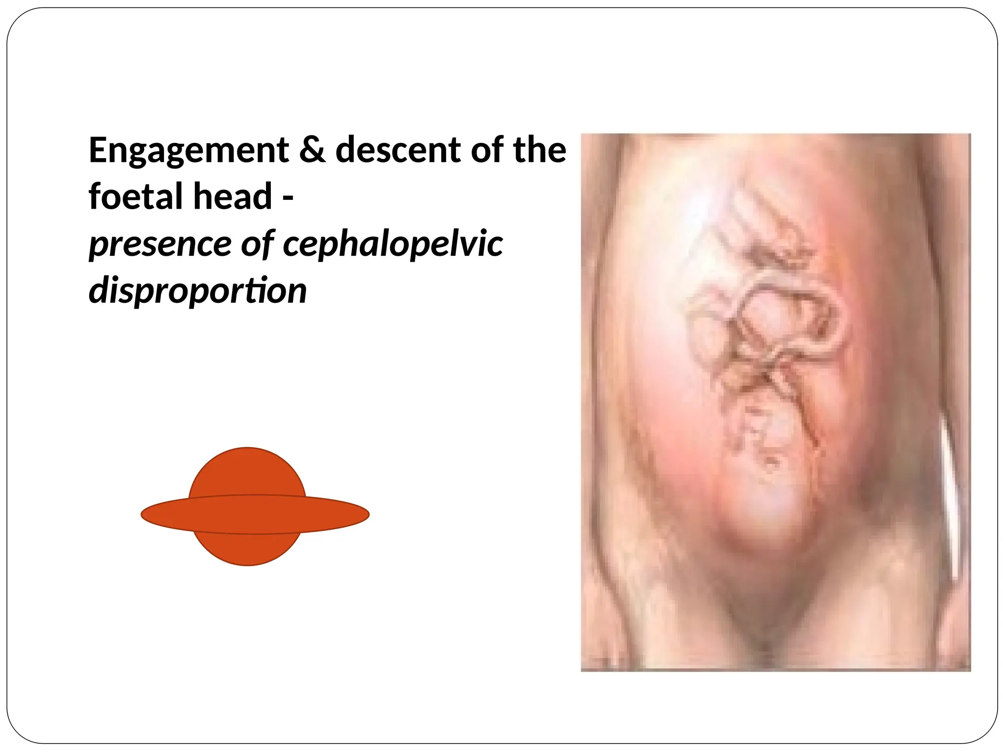 Engagement & descent of the
foetal head -
presence of cephalopelvic
disproportion
 