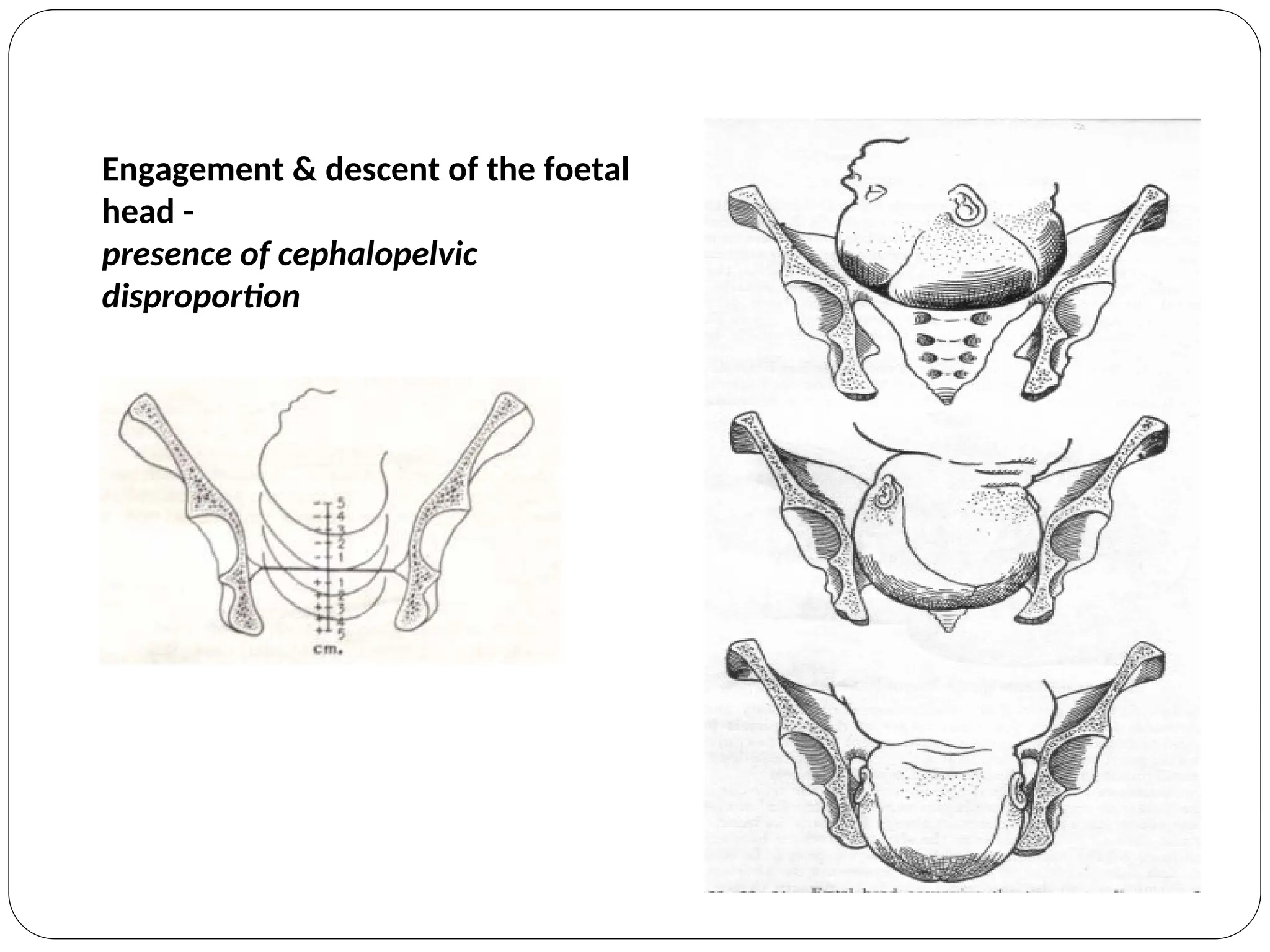 Engagement & descent of the foetal
head -
presence of cephalopelvic
disproportion
 