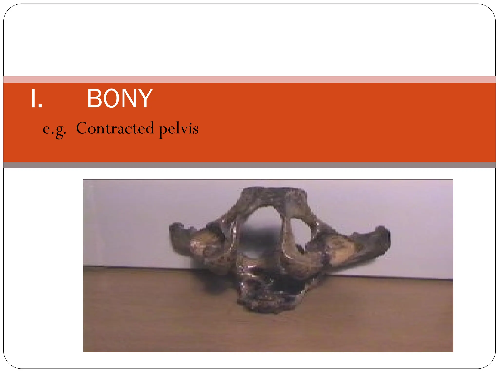 I. BONY
e.g. Contracted pelvis
 