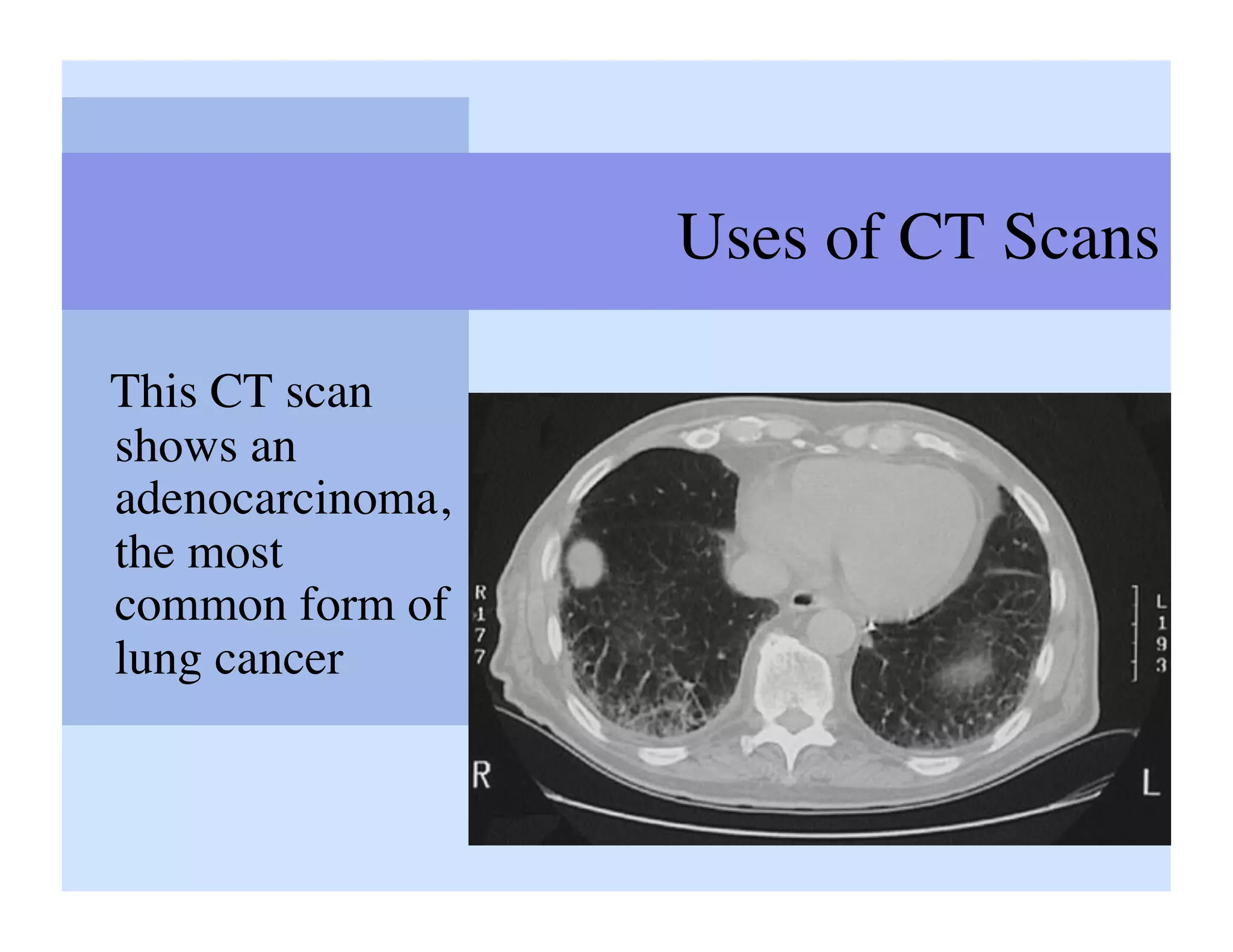 Uses of CT Scans	


This CT scan
shows an
adenocarcinoma,
the most
common form of
lung cancer	

 