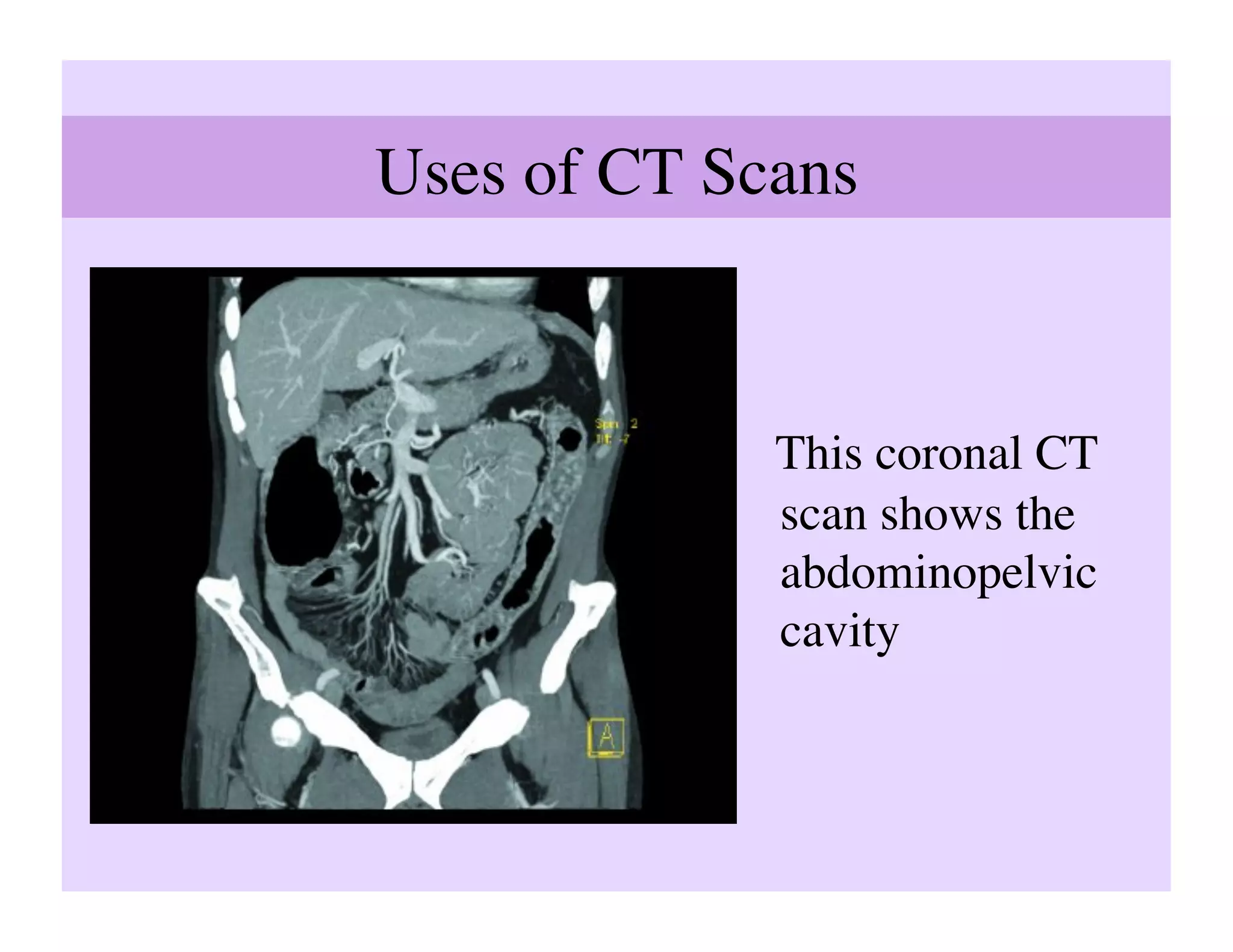 Uses of CT Scans	




               This coronal CT
               scan shows the
               abdominopelvic
               cavity	

 