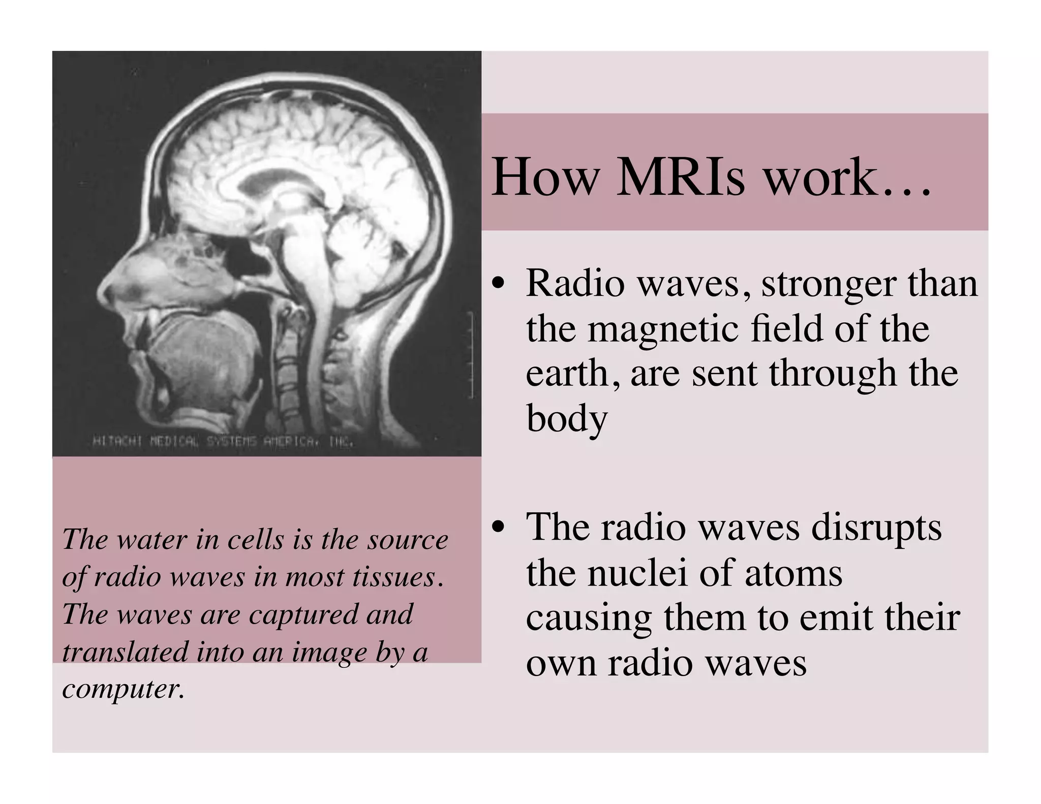 How MRIs work…	

                                   •  Radio waves, stronger than
                                      the magnetic ﬁeld of the
                                      earth, are sent through the
                                      body	


The water in cells is the source   •  The radio waves disrupts
of radio waves in most tissues.       the nuclei of atoms
The waves are captured and            causing them to emit their
translated into an image by a         own radio waves	

computer.	

 