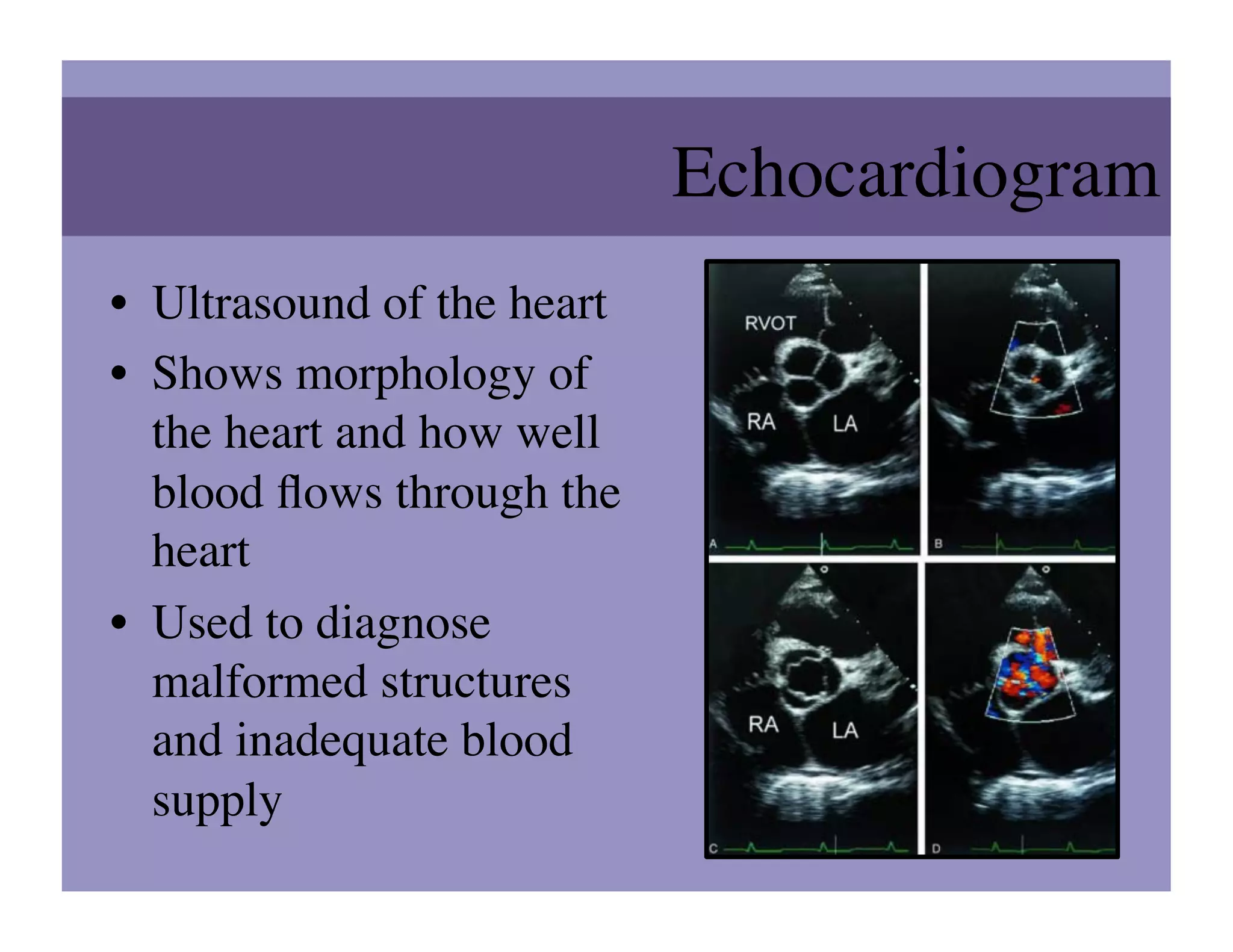 Echocardiogram 	

•  Ultrasound of the heart	

•  Shows morphology of
   the heart and how well
   blood ﬂows through the
   heart	

•  Used to diagnose
   malformed structures
   and inadequate blood
   supply	

 