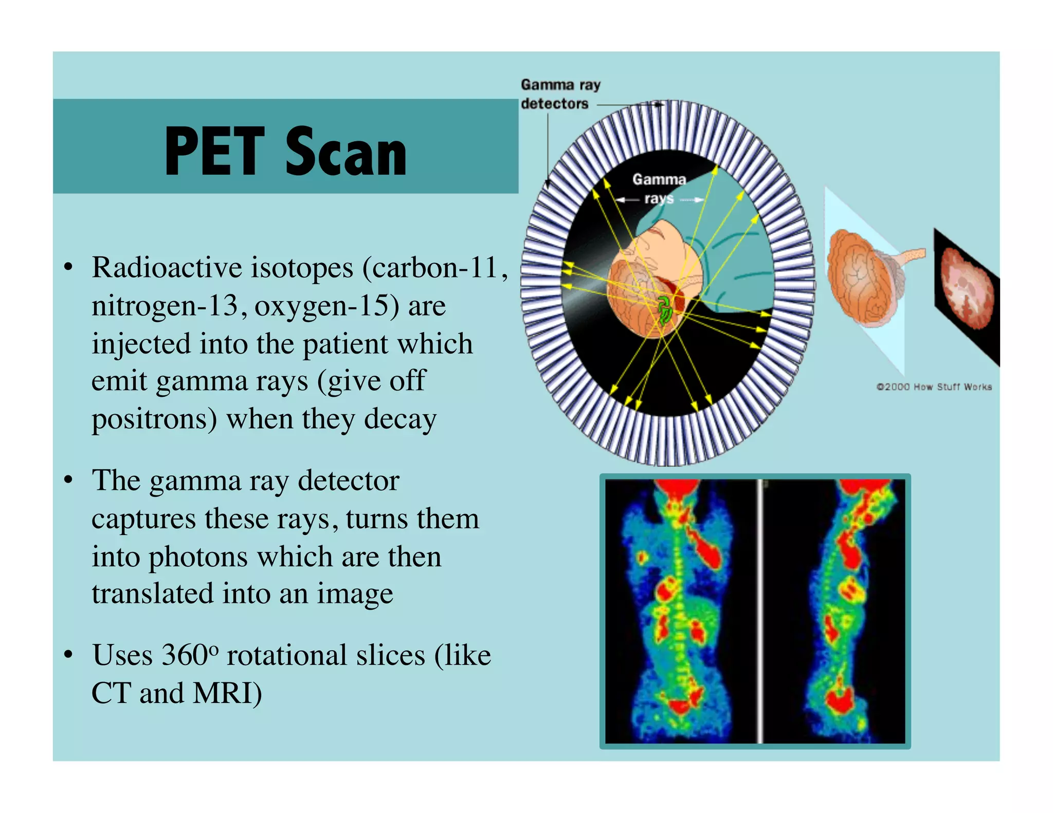 PET Scan
•  Radioactive isotopes (carbon-11,
   nitrogen-13, oxygen-15) are
   injected into the patient which
   emit gamma rays (give off
   positrons) when they decay	

•  The gamma ray detector
   captures these rays, turns them
   into photons which are then
   translated into an image	

•  Uses 360o rotational slices (like
   CT and MRI)	

 