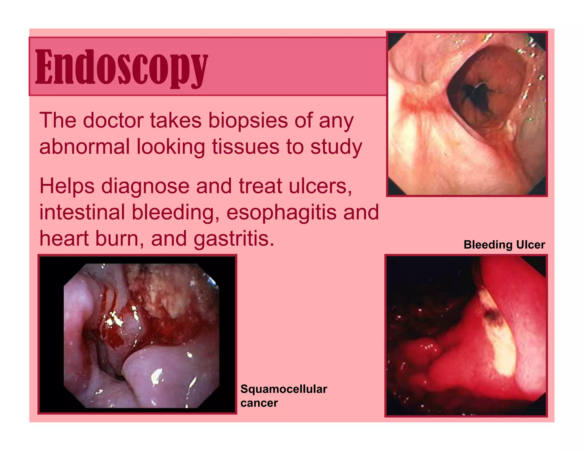 Endoscopy
The doctor takes biopsies of any
abnormal looking tissues to study
Helps diagnose and treat ulcers,
intestinal bleeding, esophagitis and
heart burn, and gastritis.             Bleeding Ulcer




                     Squamocellular
                     cancer
 