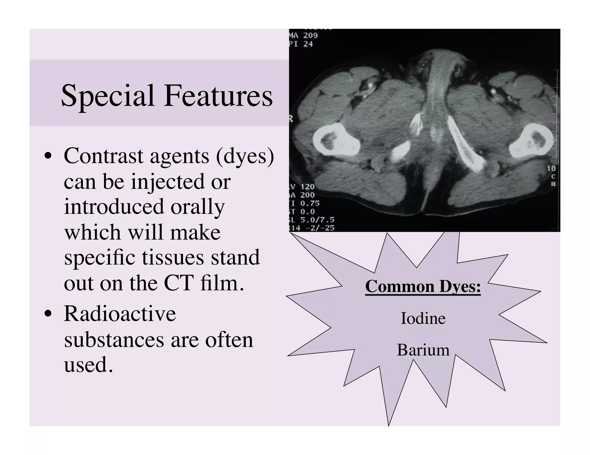 Special Features	

•  Contrast agents (dyes)
   can be injected or
   introduced orally
   which will make
   speciﬁc tissues stand
   out on the CT ﬁlm.	

    Common Dyes:
                                       	

•  Radioactive                  Iodine
                                     	

   substances are often        Barium	

   used.	

 
