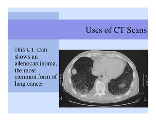 Uses of CT Scans	


This CT scan
shows an
adenocarcinoma,
the most
common form of
lung cancer	

 