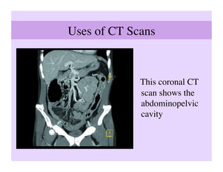 Uses of CT Scans	




               This coronal CT
               scan shows the
               abdominopelvic
               cavity	

 