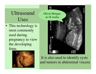 Ultrasound             Olivia Morgan
                           at 18 weeks	

      Uses	

•  This technology is
   most commonly
   used during
   pregnancy to view
   the developing
   fetus	


                         It is also used to identify cysts
                        and tumors in abdominal viscera    	

 