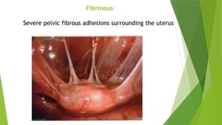 Fibrinous
Severe pelvic fibrous adhesions surrounding the uterus
 