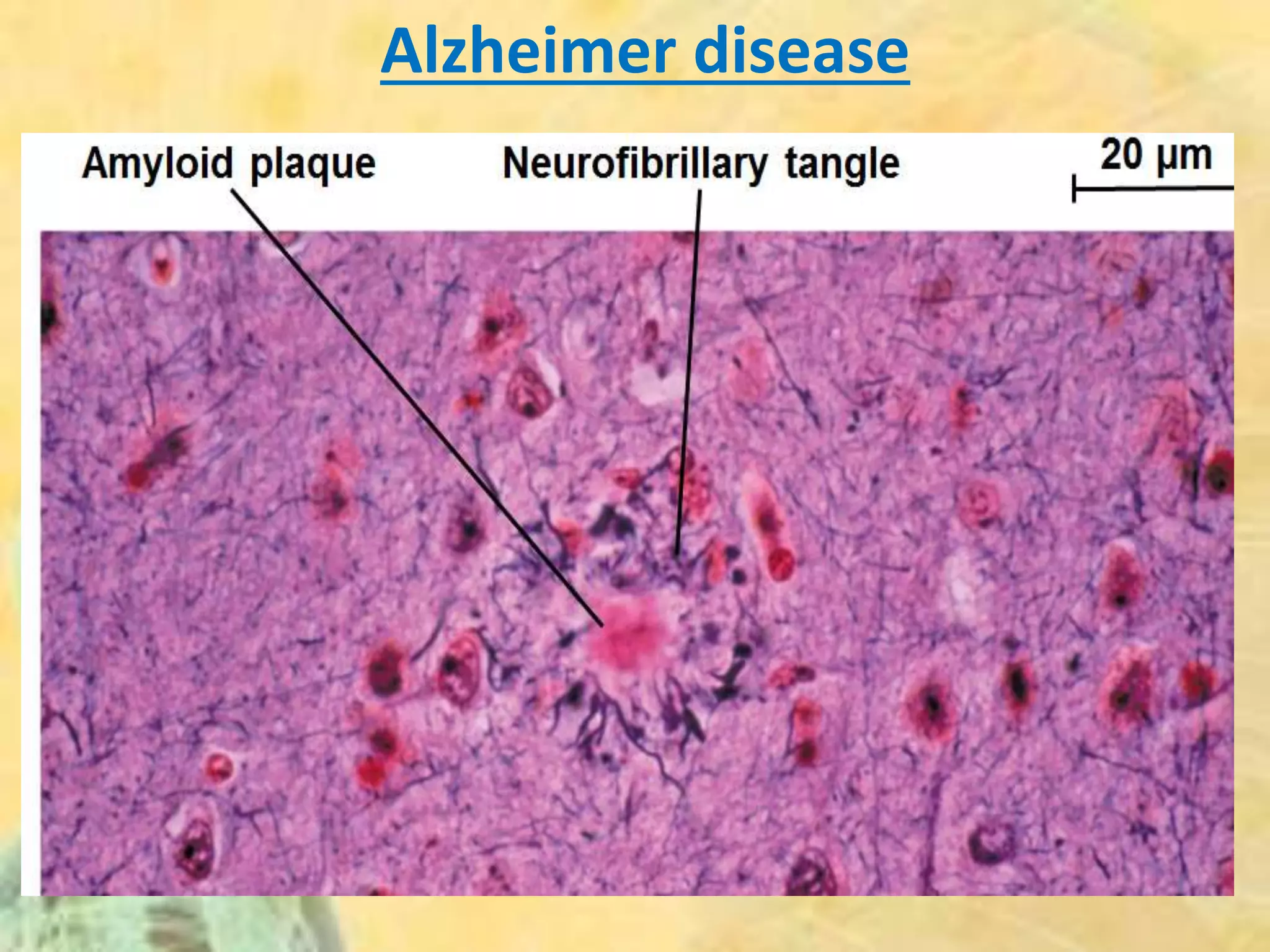 Alzheimer disease
 