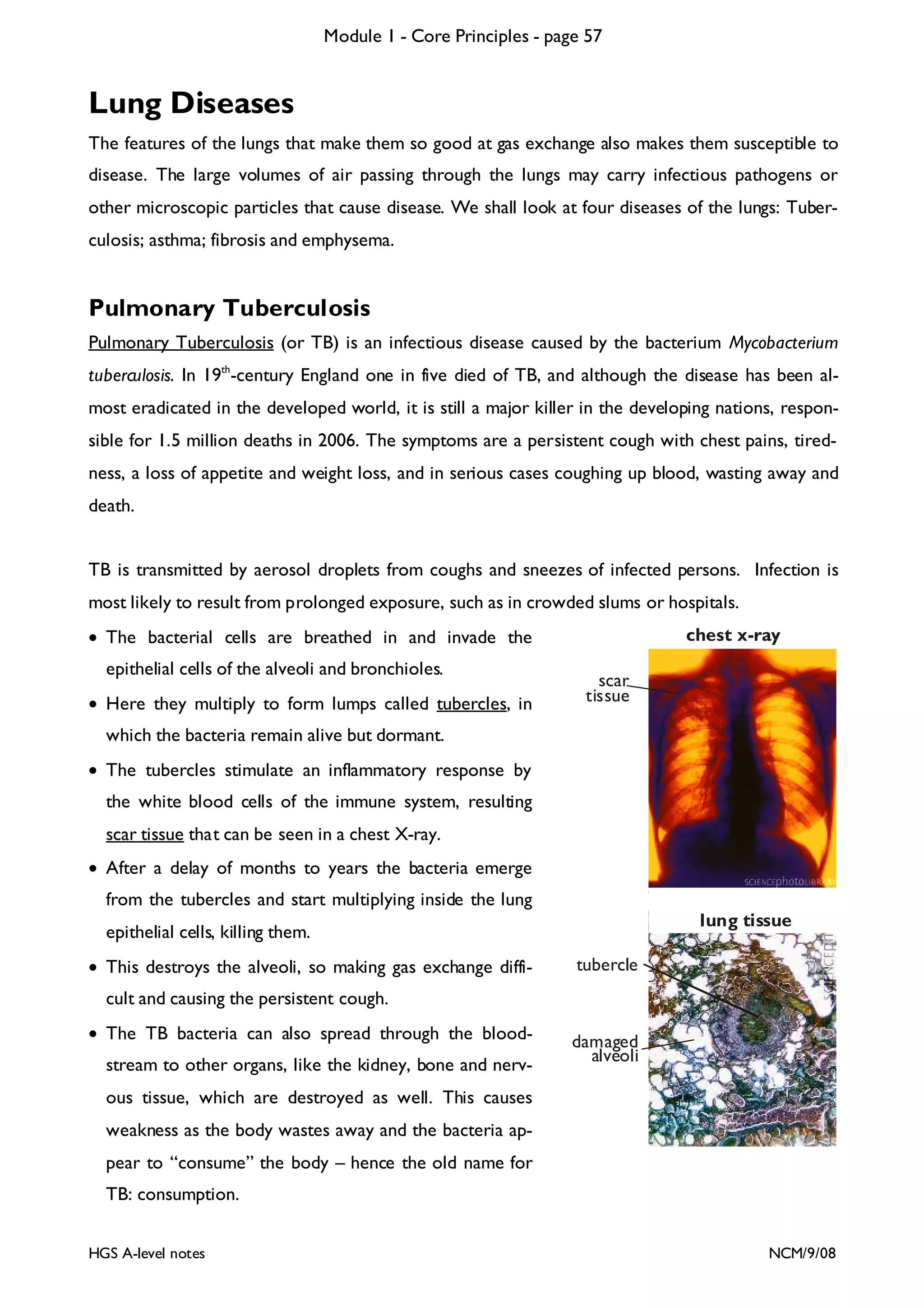 Module 1 - Core Principles - page 57

Lung Diseases
The features of the lungs that make them so good at gas exchange also makes them susceptible to
disease. The large volumes of air passing through the lungs may carry infectious pathogens or
other microscopic particles that cause disease. We shall look at four diseases of the lungs: Tuberculosis; asthma; fibrosis and emphysema.

Pulmonary Tuberculosis
Pulmonary Tuberculosis (or TB) is an infectious disease caused by the bacterium Mycobacterium
tuberculosis. In 19th-century England one in five died of TB, and although the disease has been al-

most eradicated in the developed world, it is still a major killer in the developing nations, responsible for 1.5 million deaths in 2006. The symptoms are a persistent cough with chest pains, tiredness, a loss of appetite and weight loss, and in serious cases coughing up blood, wasting away and
death.
TB is transmitted by aerosol droplets from coughs and sneezes of infected persons. Infection is
most likely to result from prolonged exposure, such as in crowded slums or hospitals.
• The bacterial cells are breathed in and invade the
epithelial cells of the alveoli and bronchioles.
• Here they multiply to form lumps called tubercles, in

chest x-ray
scar
tissue

which the bacteria remain alive but dormant.
• The tubercles stimulate an inflammatory response by
the white blood cells of the immune system, resulting
scar tissue that can be seen in a chest X-ray.
• After a delay of months to years the bacteria emerge
from the tubercles and start multiplying inside the lung
lung tissue

epithelial cells, killing them.
• This destroys the alveoli, so making gas exchange diffi-

tubercle

cult and causing the persistent cough.
• The TB bacteria can also spread through the bloodstream to other organs, like the kidney, bone and nerv-

damaged
alveoli

ous tissue, which are destroyed as well. This causes
weakness as the body wastes away and the bacteria appear to “consume” the body – hence the old name for
TB: consumption.
HGS A-level notes

NCM/9/08

 
