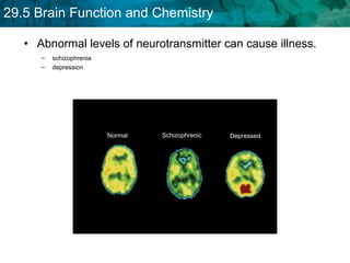 Abnormal levels of neurotransmitter can cause illness. schizophrenia depression  Normal Schizophrenic Depressed 