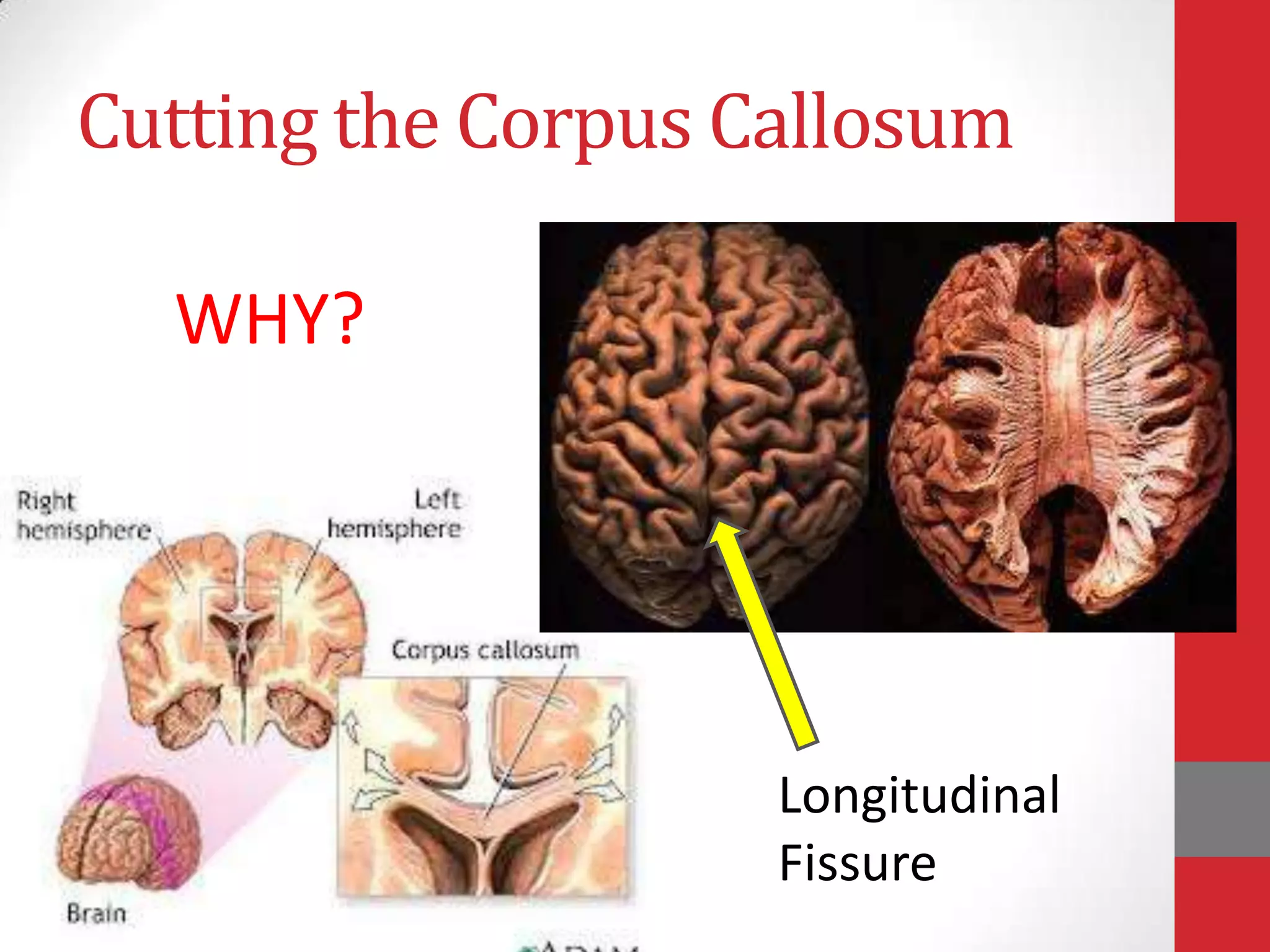 Cutting the Corpus Callosum
WHY?

Longitudinal
Fissure

 