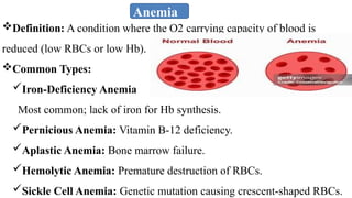 Anemia
Definition: A condition where the O2​carrying capacity of blood is
reduced (low RBCs or low Hb).
Common Types:
Iron-Deficiency Anemia
Most common; lack of iron for Hb synthesis.
Pernicious Anemia: Vitamin B-12 deficiency.
Aplastic Anemia: Bone marrow failure.
Hemolytic Anemia: Premature destruction of RBCs.
Sickle Cell Anemia: Genetic mutation causing crescent-shaped RBCs.
 