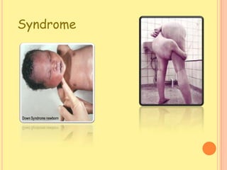 Syndrome