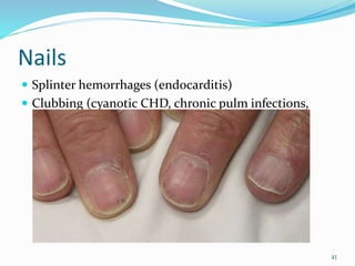 Nails
 Splinter hemorrhages (endocarditis)
 Clubbing (cyanotic CHD, chronic pulm infections,
cirrhosis)
41
 