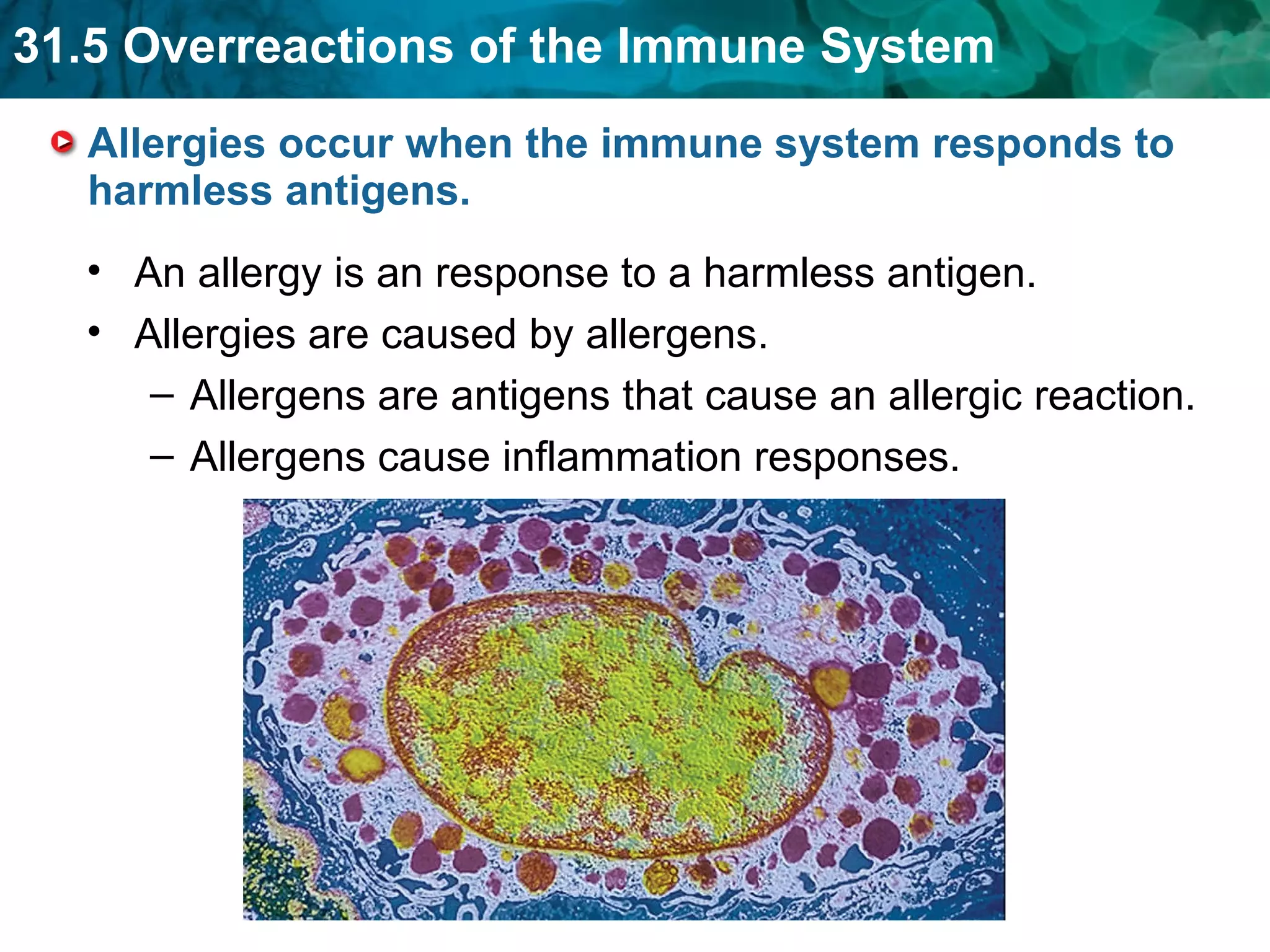 Allergies occur when the immune system responds to harmless antigens. An allergy is an response to a harmless antigen. Allergies are caused by allergens. Allergens are antigens that cause an allergic reaction. Allergens cause inflammation responses. 