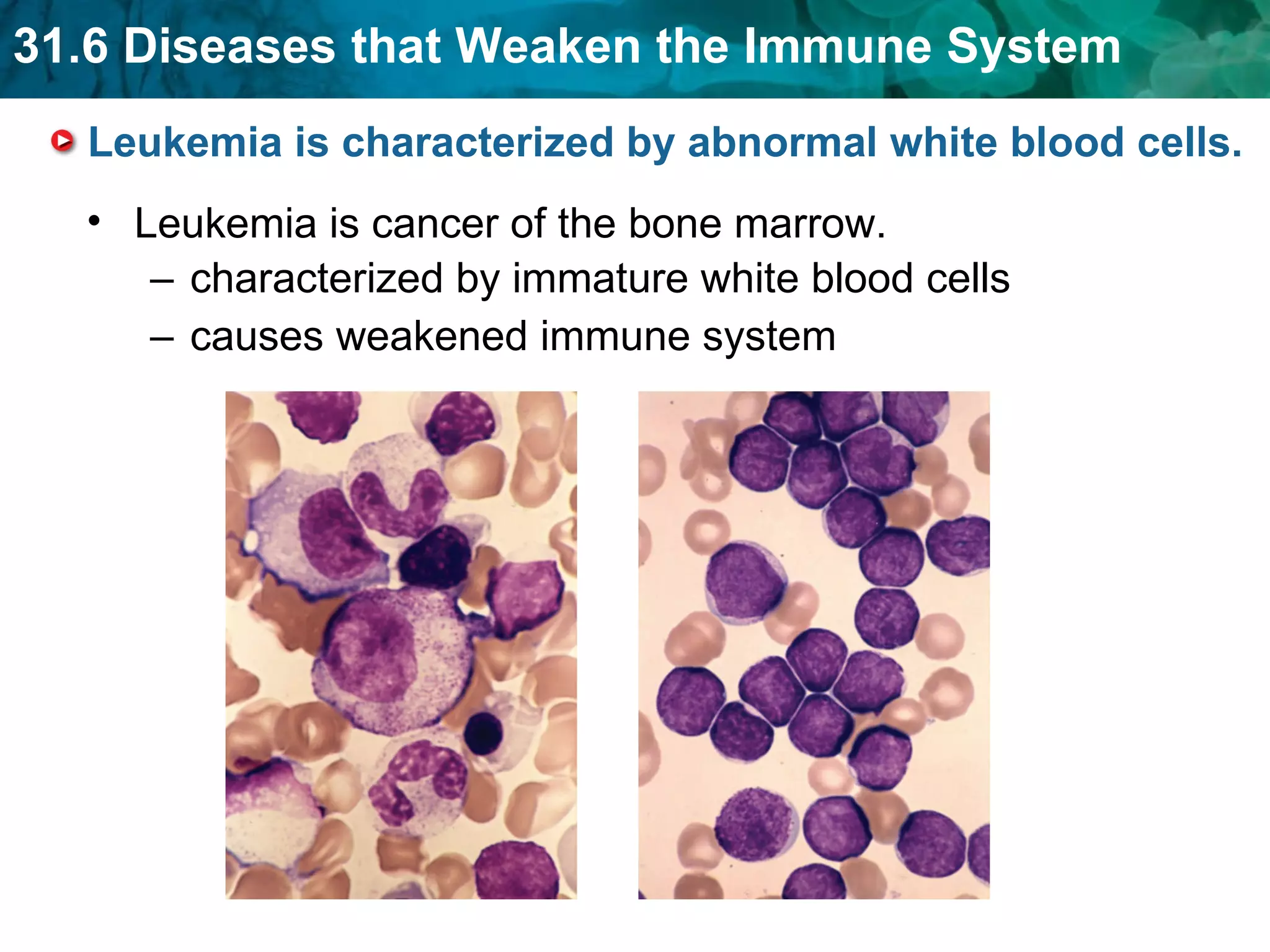 Leukemia is characterized by abnormal white blood cells. characterized by immature white blood cells   causes weakened immune system Leukemia is cancer of the bone marrow. 