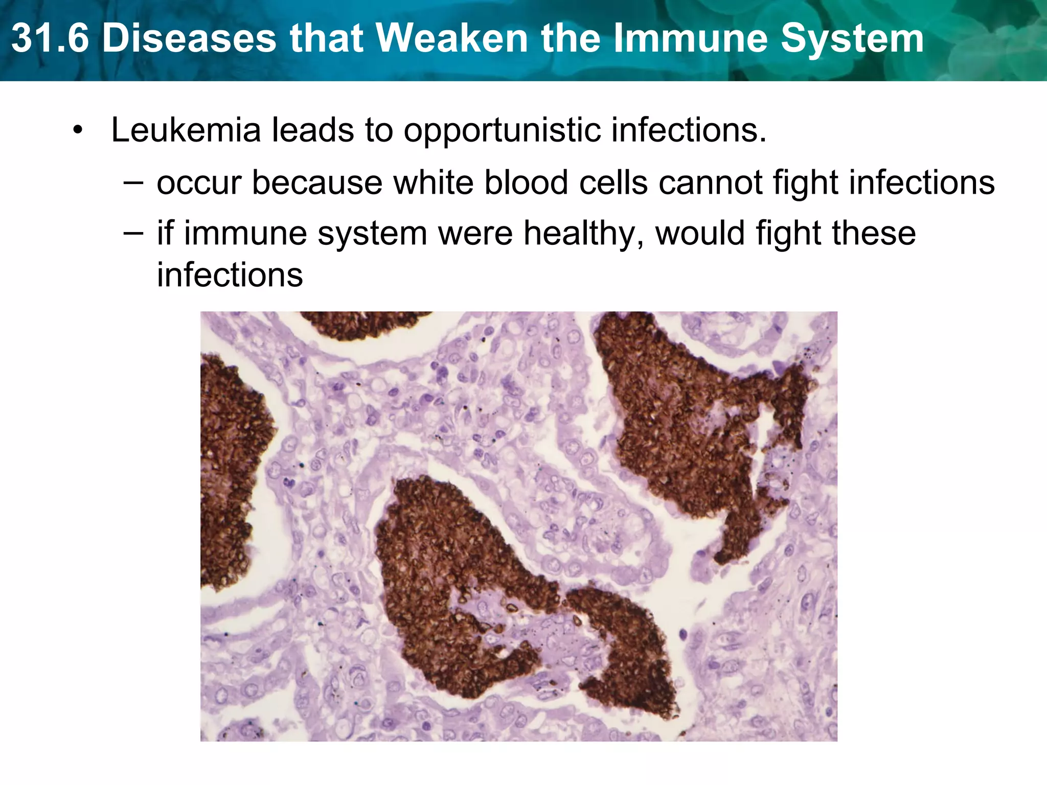 Leukemia leads to opportunistic infections. occur because white blood cells cannot fight infections if immune system were healthy, would fight these infections 