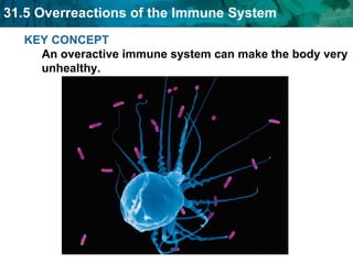 KEY CONCEPT An overactive immune system can make the body very unhealthy. 