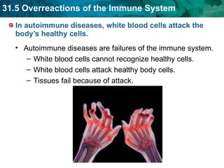 In autoimmune diseases, white blood cells attack the body’s healthy cells. Autoimmune diseases are failures of the immune system. White blood cells cannot recognize healthy cells. White blood cells attack healthy body cells. Tissues fail because of attack. 