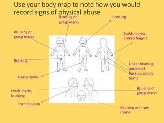 Use your body map to note how you would
record signs of physical abuse
Bruising or
grasp marks
Bruising or
grasp marks
Bruising
Bruising or finger
marks
Bruising or
grasp marks
Scalds, burns,
broken fingers
Linear bruising,
outline of
buckles, scalds,
burnsGrasp marks
Bruising
Torn fenulum
Pinch marks,
bruising
 