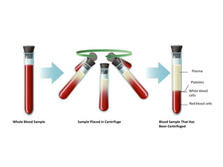 Plasma
Platelets
White blood
cells
Red blood cells

Whole Blood Sample

Sample Placed in Centrifuge

Blood Sample That Has
Been Centrifuged

 