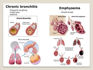 Chronic bronchitis
-Frequent coughing
-Chest pain
-Asthma
Emphysema
-Alveoli break
 