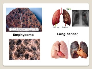 Emphysema Lung cancer
 