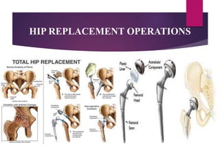 HIP REPLACEMENT OPERATIONS
 