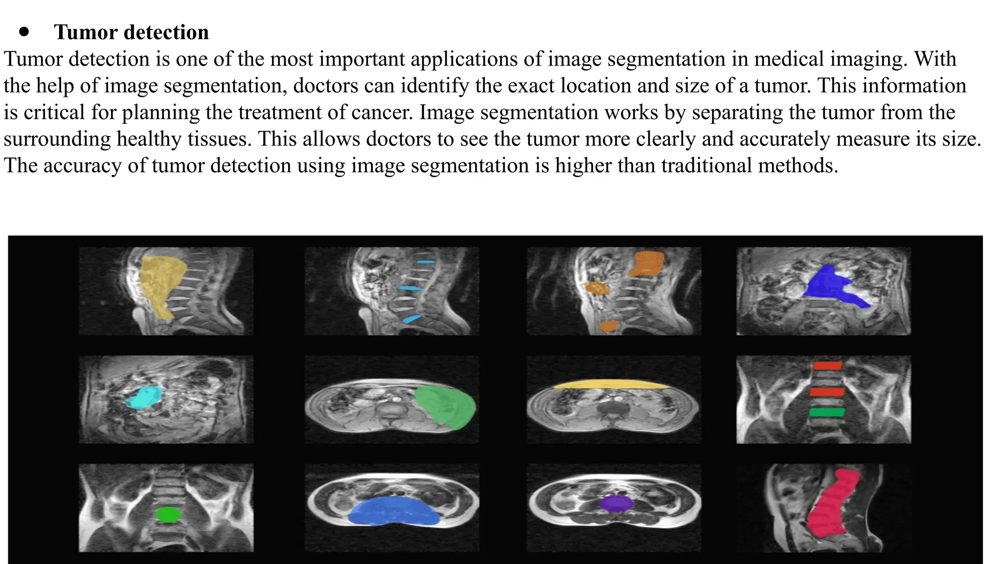 ● Tumor detection
Tumor detection is one of the most important applications of image segmentation in medical imaging. With
the help of image segmentation, doctors can identify the exact location and size of a tumor. This information
is critical for planning the treatment of cancer. Image segmentation works by separating the tumor from the
surrounding healthy tissues. This allows doctors to see the tumor more clearly and accurately measure its size.
The accuracy of tumor detection using image segmentation is higher than traditional methods.
 