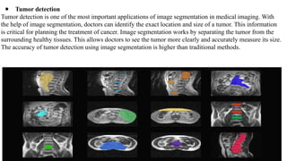 ● Tumor detection
Tumor detection is one of the most important applications of image segmentation in medical imaging. With
the help of image segmentation, doctors can identify the exact location and size of a tumor. This information
is critical for planning the treatment of cancer. Image segmentation works by separating the tumor from the
surrounding healthy tissues. This allows doctors to see the tumor more clearly and accurately measure its size.
The accuracy of tumor detection using image segmentation is higher than traditional methods.
 